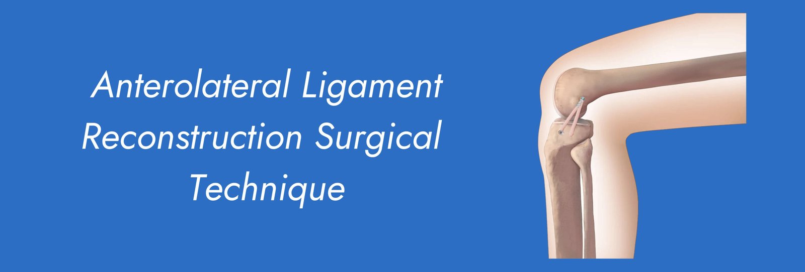 Anterolateral Ligament Reconstruction Surgical Technique