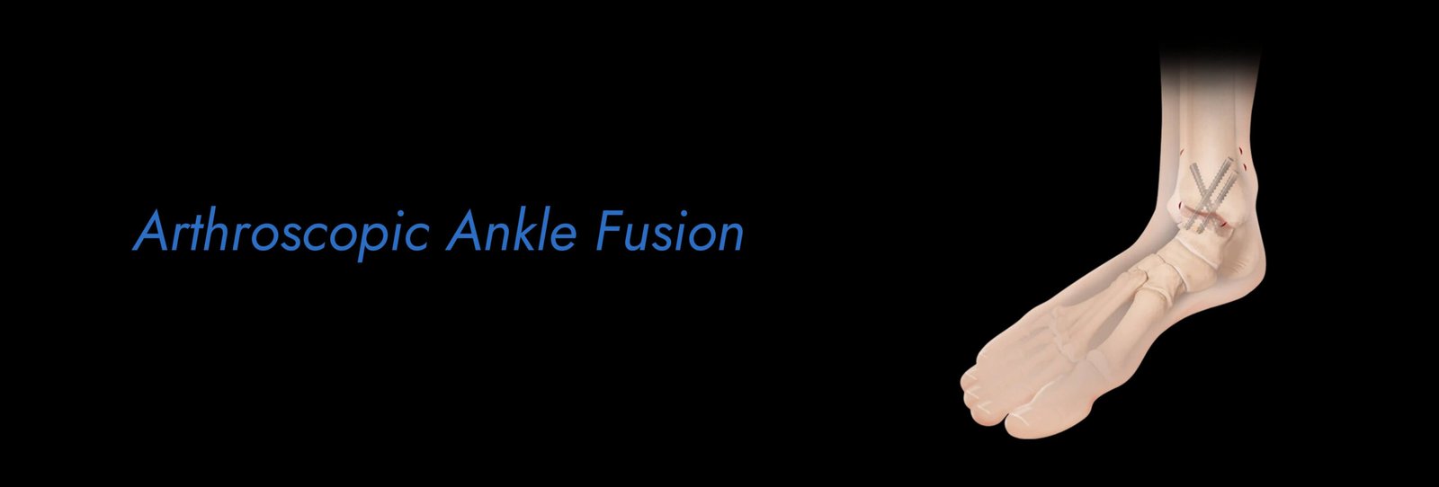 Arthroscopic Ankle Fusion