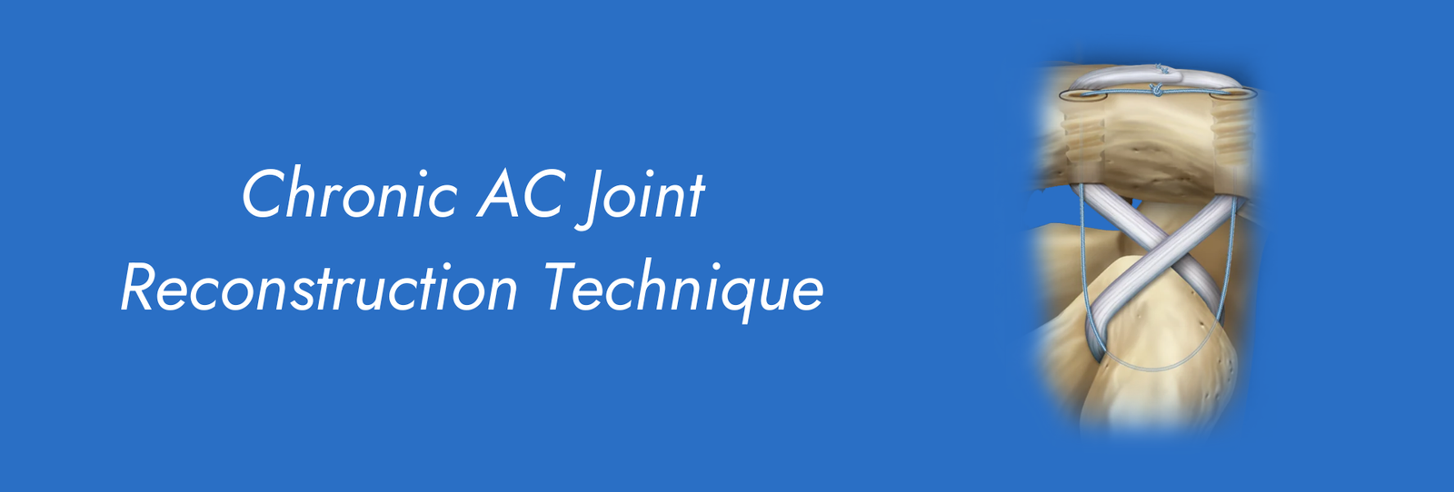 Chronic AC Joint Reconstruction Technique