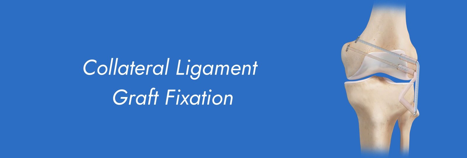 Collateral Ligament Graft Fixation