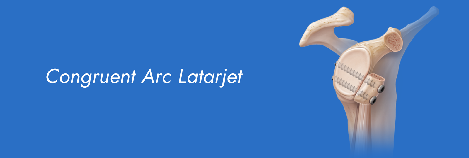 Congruent Arc Latarjet