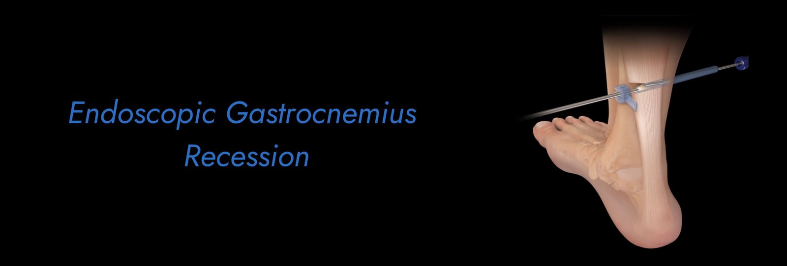 Endoscopic Gastrocnemius Recession