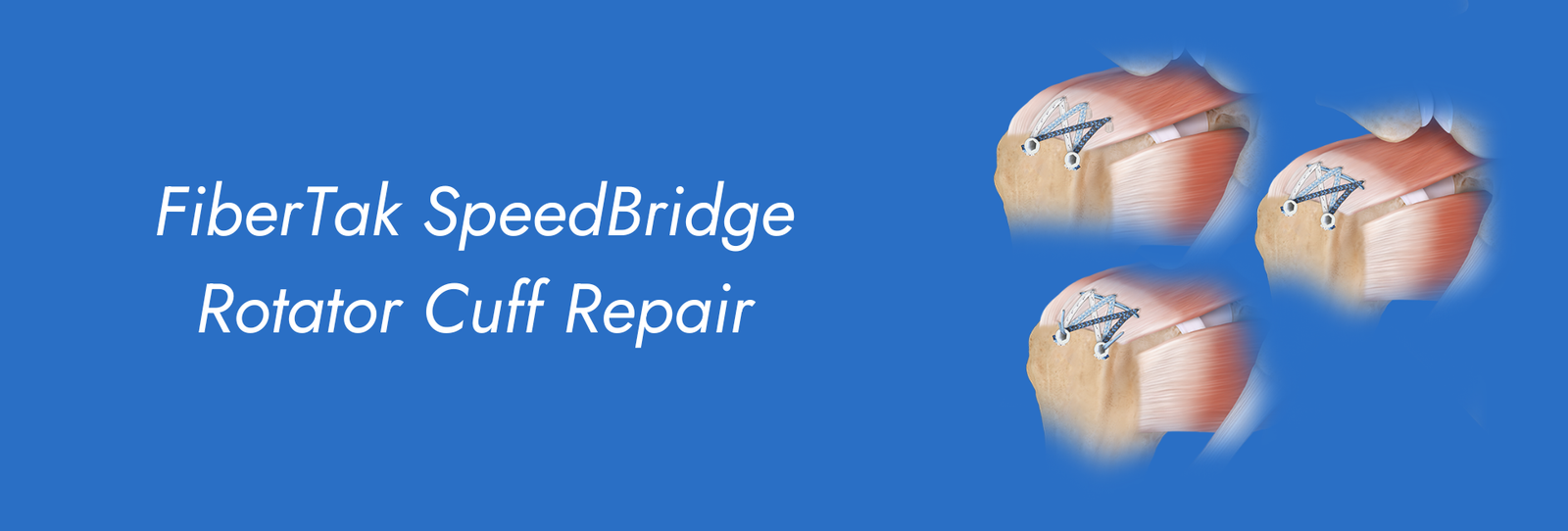 FiberTak SpeedBridge Rotator Cuff Repair