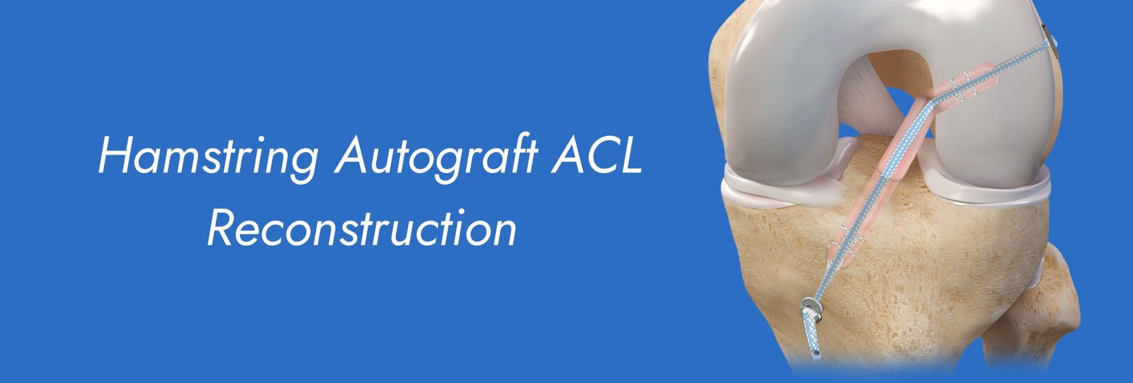 Hamstring Autograft ACL Reconstruction