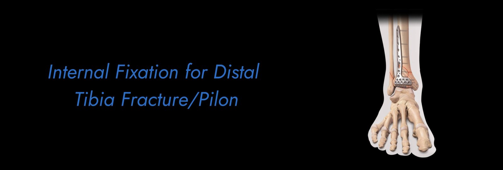 Internal Fixation for Distal Tibia Fracture_Pilon