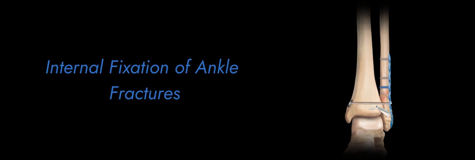 Internal Fixation of Ankle Fractures