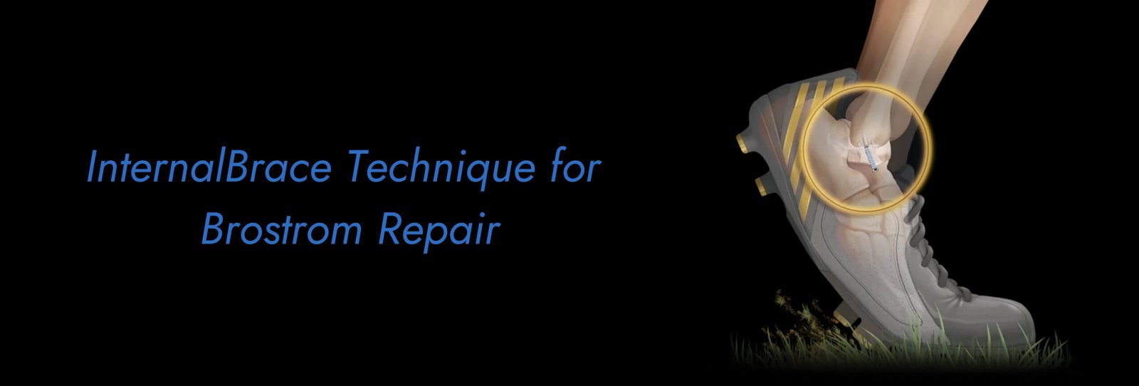 InternalBrace Technique for Brostrom Repair