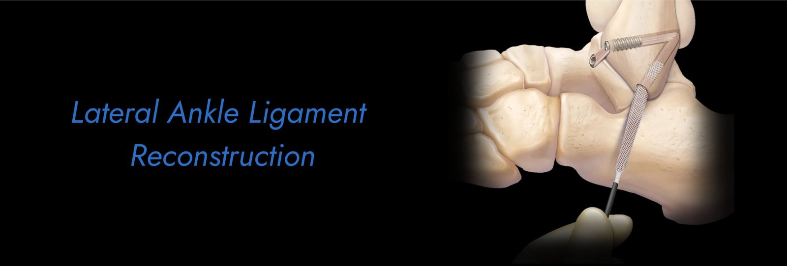 Lateral Ankle Ligament Reconstruction