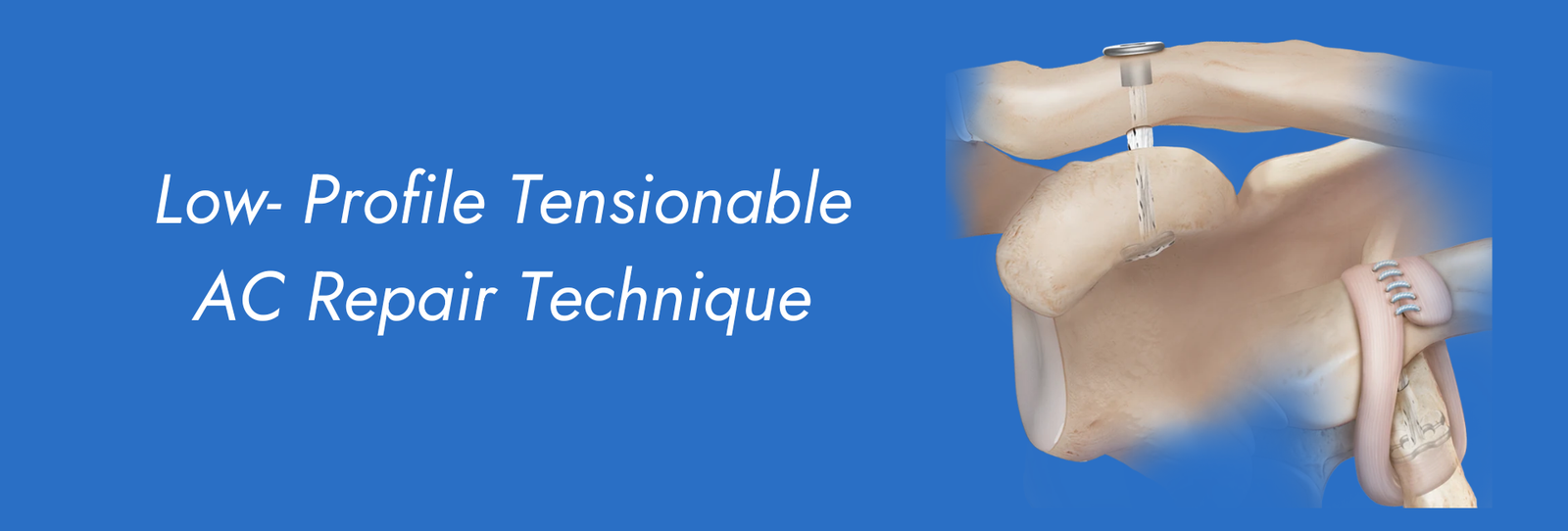 Low- Profile Tensionable AC Repair Technique