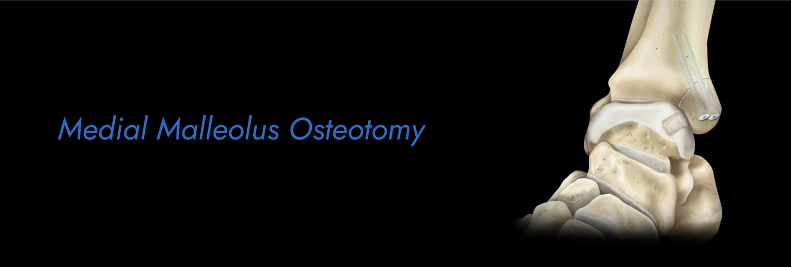 Medial Malleolus Osteotomy