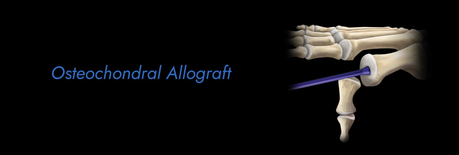 Osteochondral Allograft