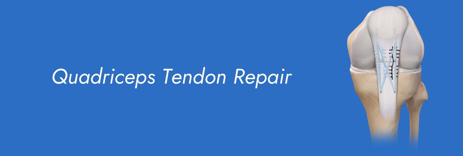 Quadriceps Tendon Repair