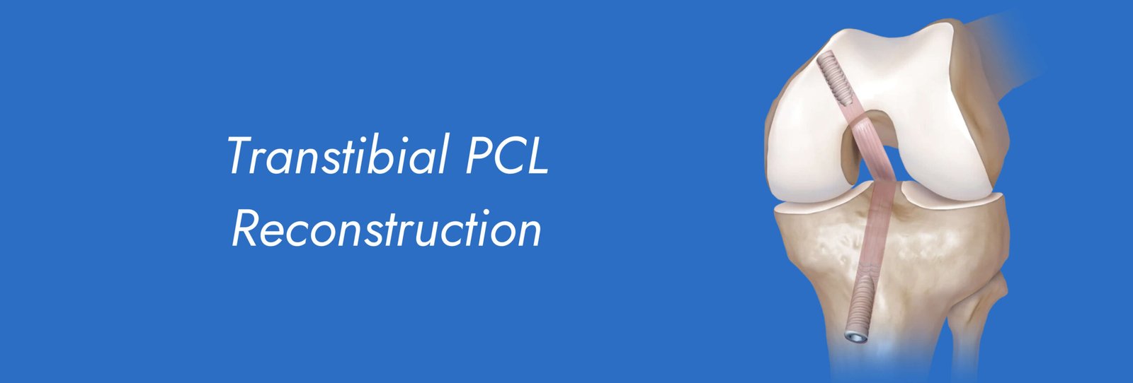 Transtibial PCL Reconstruction