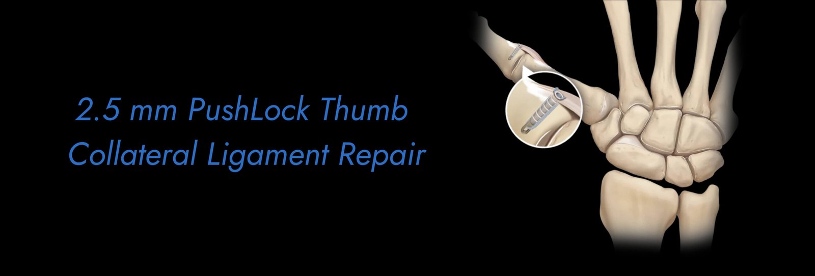 2.5 mm PushLock Thumb Collateral Ligament Repair