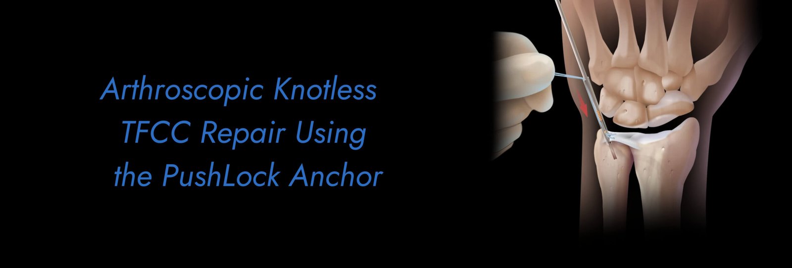 Arthroscopic Knotless TFCC Repair Using the PushLock Anchor