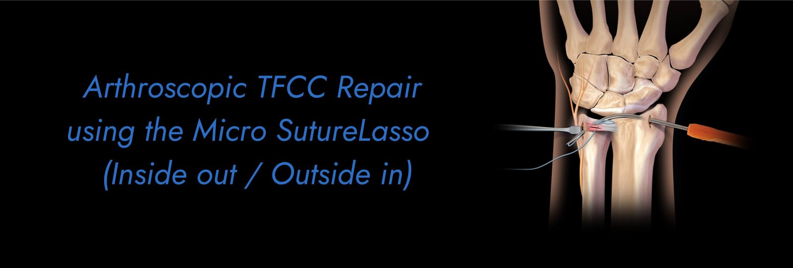 Arthroscopic TFCC Repair using the Micro SutureLasso (Inside out _ Outside in)