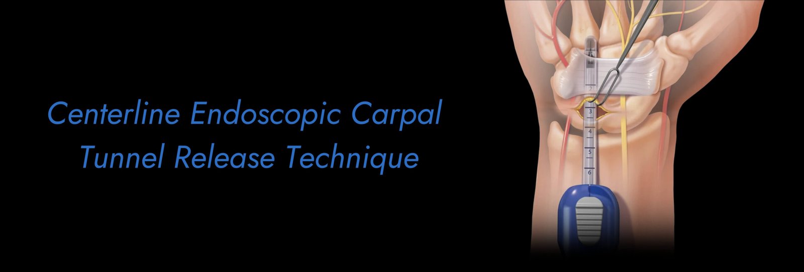 Centerline Endoscopic Carpal Tunnel Release Technique