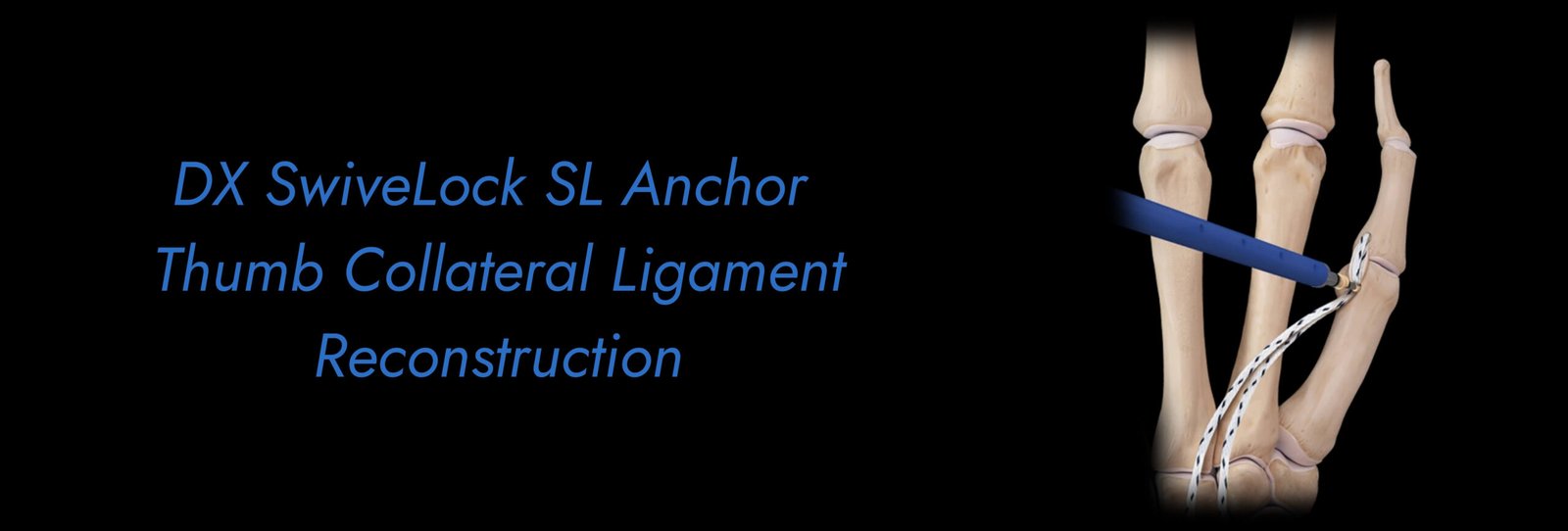 DX SwiveLock SL Anchor Thumb Collateral Ligament Reconstruction