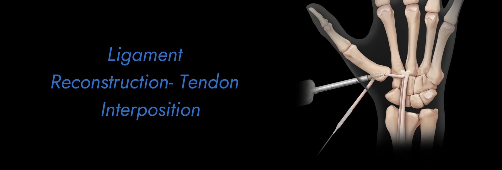 Ligament Reconstruction - Tendon Interposition