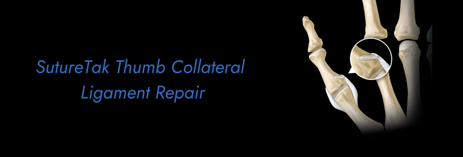 SutureTak Thumb Collateral Ligament Repair